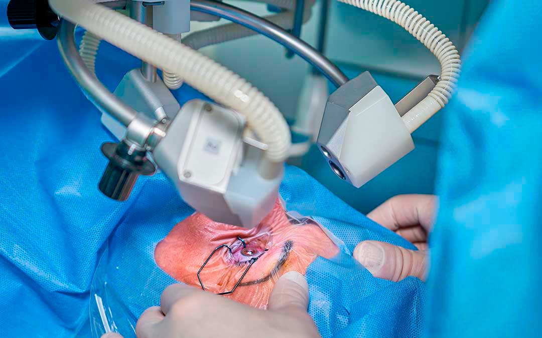 Imagen de una operación de Oftalmología./ Pixabay