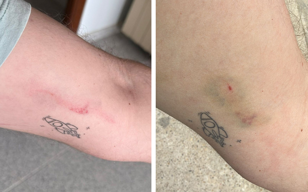 El joven tiene un arañazo y una moradura en el brazo causado por progenitores del equipo Bajo Aragón C.D. de Zaragoza / V.P.